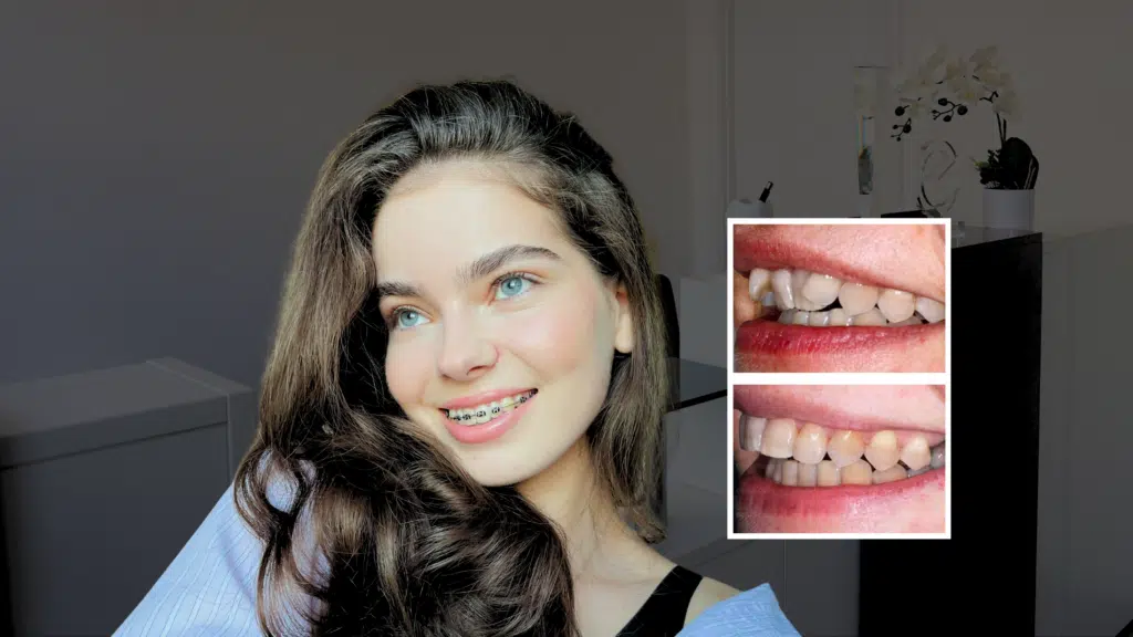 Fastbraces London