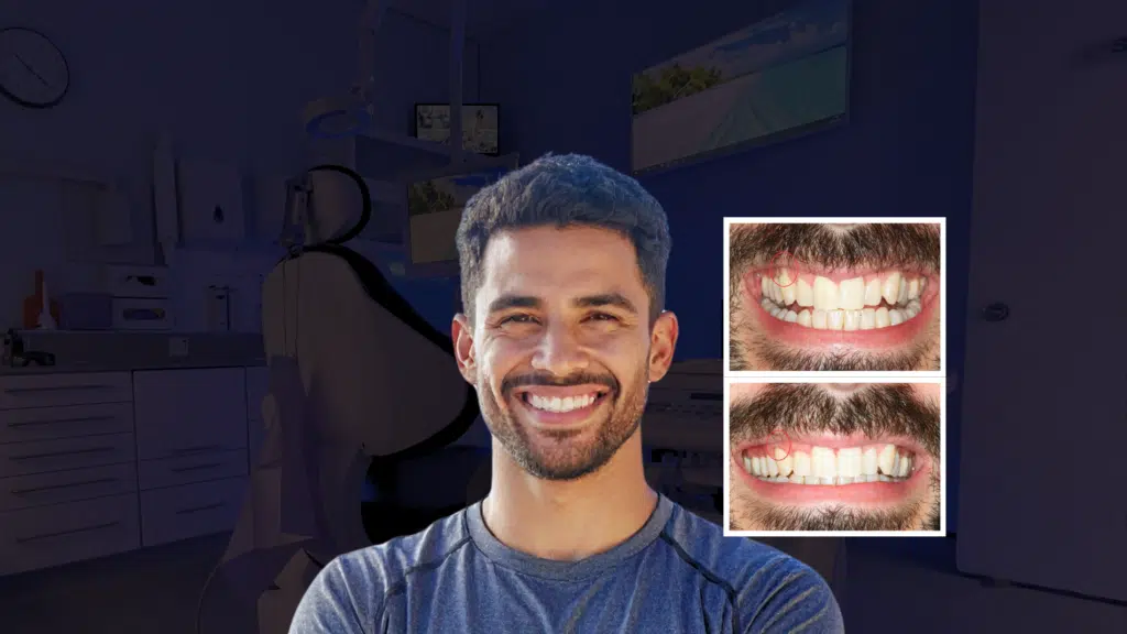 Receding gum treatment rejuvenates a patients smile, appearance and confidence.