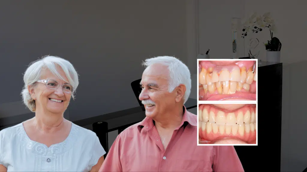 Teeth in a Day