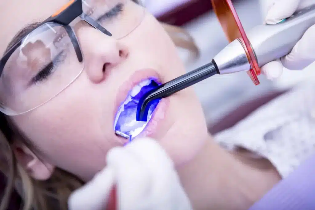 What Is Laser Gum Bleaching