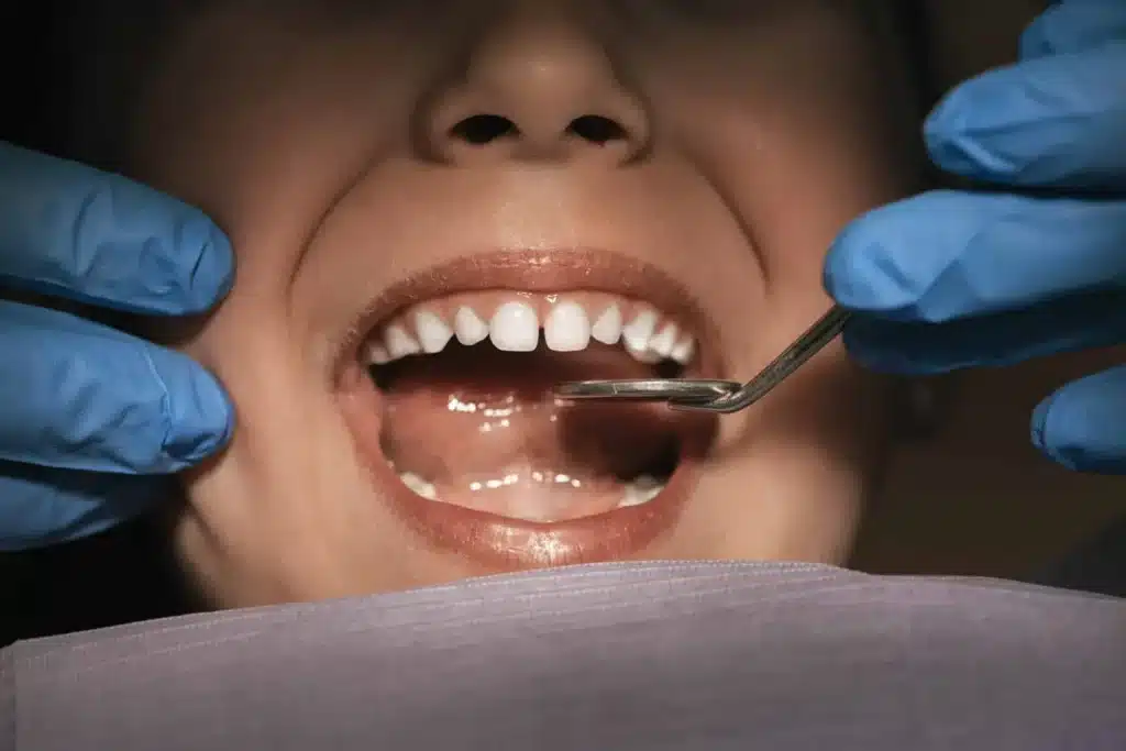Black Triangle Teeth Smile Cliniq’s
