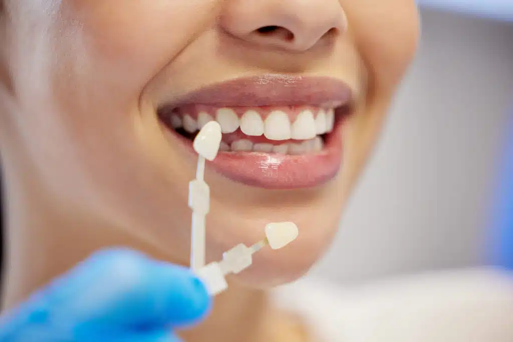 Dental Veneers