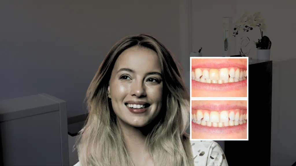 Happy patient overjoyed at new smile after black teeth treatment in london