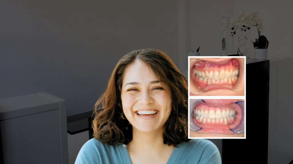 Ceramic Braces London treatment