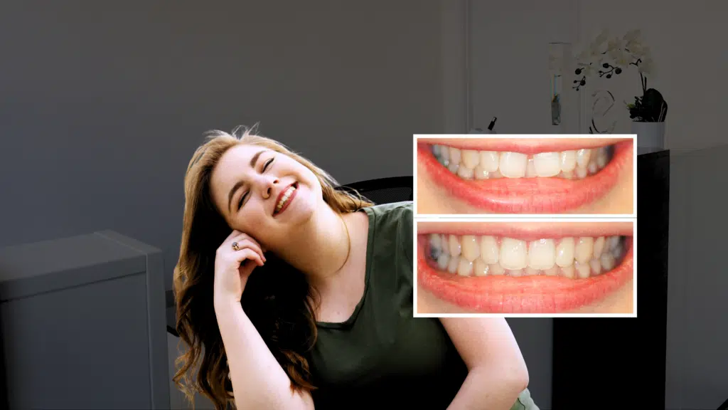 Diastema closure smile cliniq