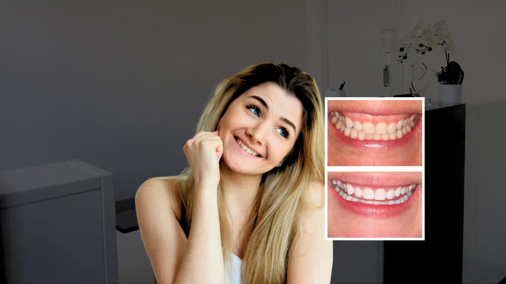 Gummy Smile Treatment