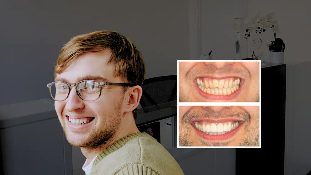 Man smiling confidently after cosmetic dental treatment, shown alongside a before-and-after smile makeover comparison featuring whiter, straighter teeth in London