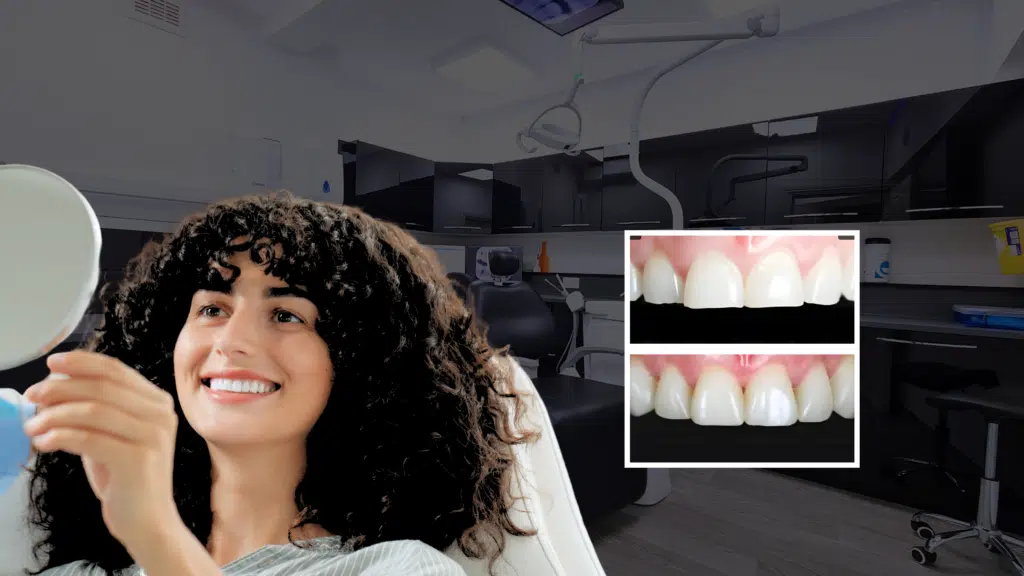Tooth Surface Loss Treatment in London