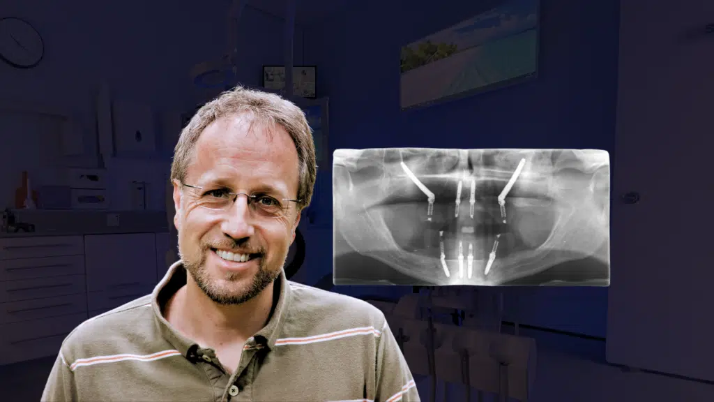 Zygomatic Implants