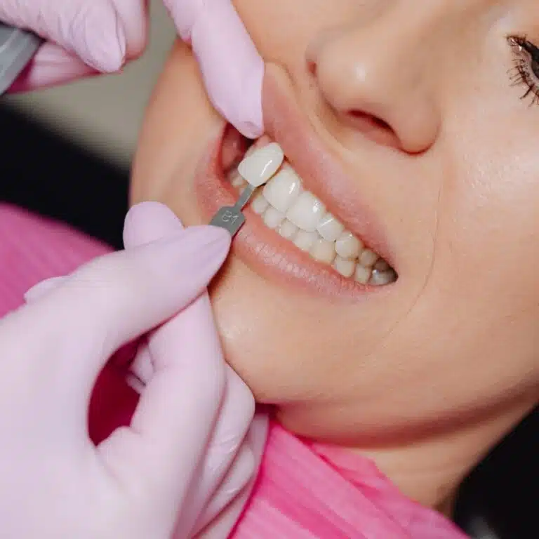 a dentist fitting a veneer tooth on a patient