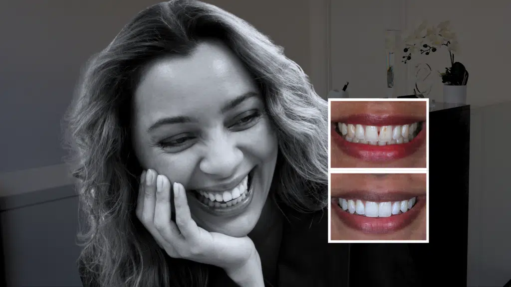 black triangle teeth at smile cliniq london