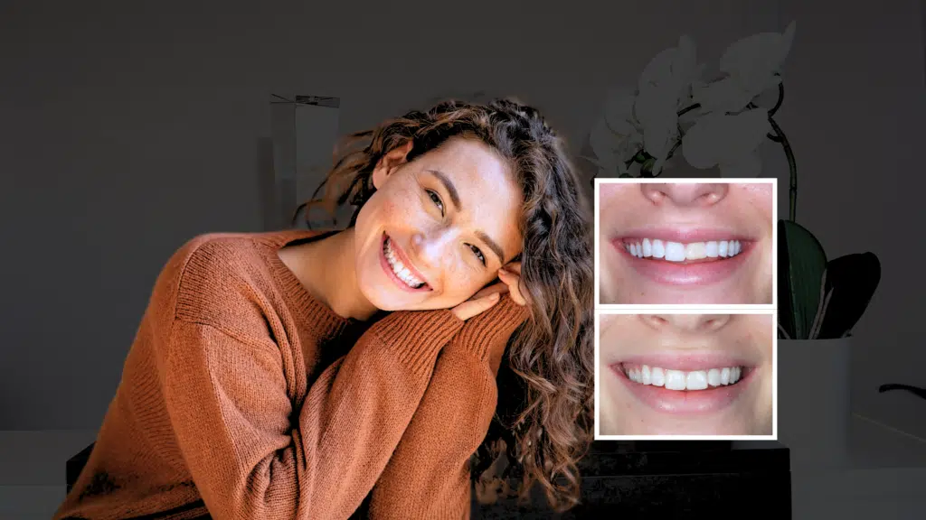 Patient showing a bright, natural smile after receiving dental crowns in London