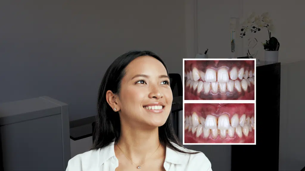 Laser Gum Bleaching