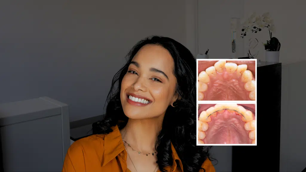 Lingual Braces London