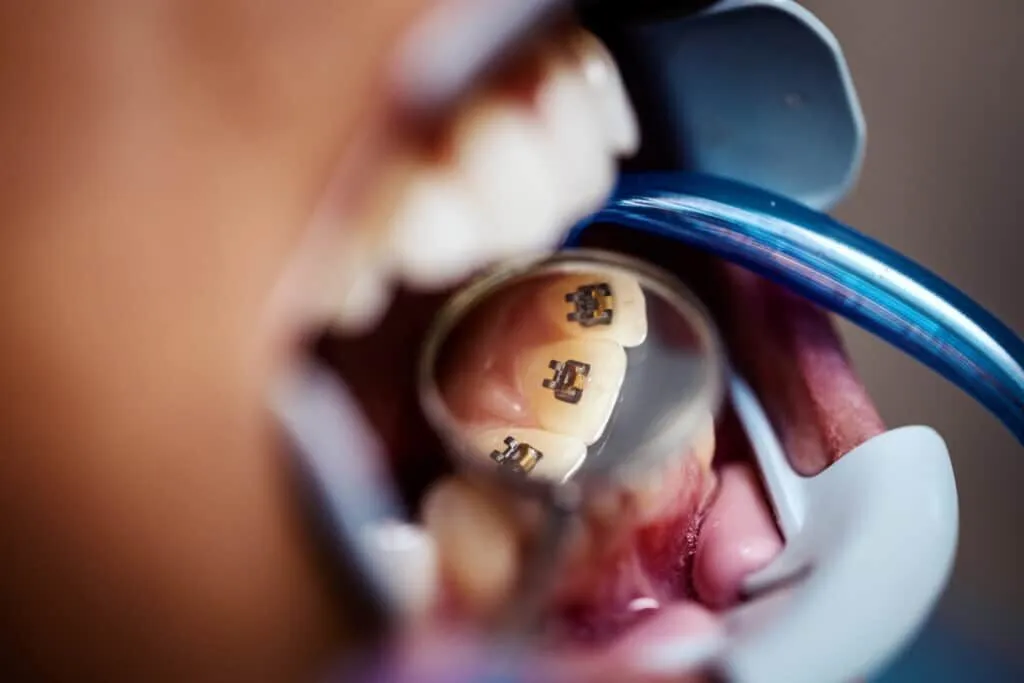 Best Lingual Braces London